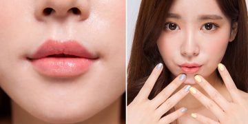 Phẫu thuật thẩm mỹ nâng khóe môi - 01