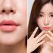 Phẫu thuật thẩm mỹ nâng khóe môi - 01