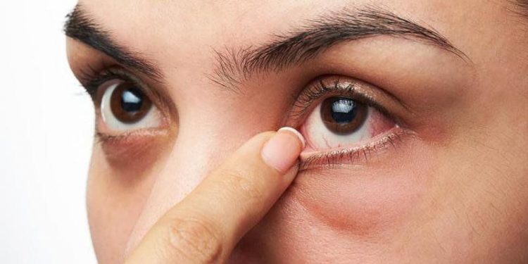 Bệnh đau mắt đỏ không kinh khủng như mọi người nghĩ 2