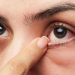 Bệnh đau mắt đỏ không kinh khủng như mọi người nghĩ 2