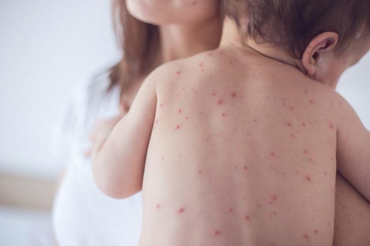 Cẩn thận trước những thông tin thiếu khoa học về bệnh sởi 1