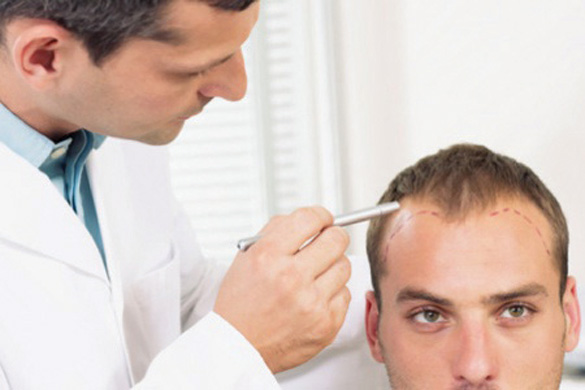 Giải pháp cứu nguy cho nam giới bị tóc rụng 3