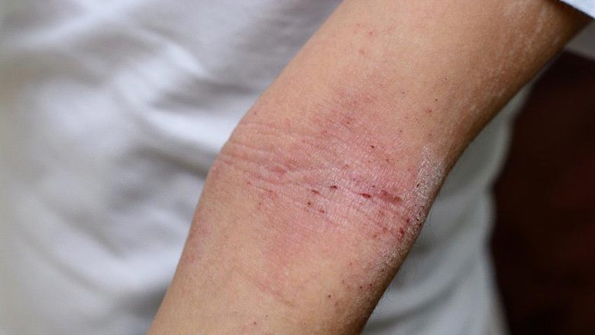 Phát ban hoặc eczema