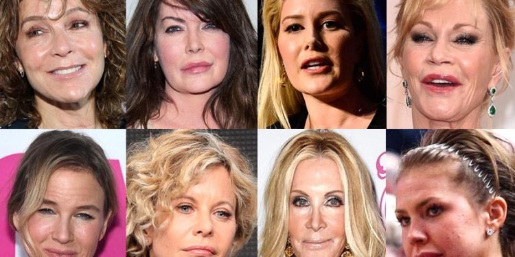 Những ngôi sao điện ảnh tự hủy hoại sự nghiệp vì phẫu thuật thẩm mỹ