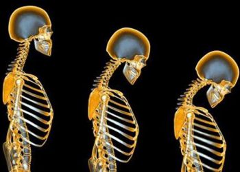 Vấn đề loãng xương - Những gì bác sĩ không nói cho bạn biết về xương của bạn