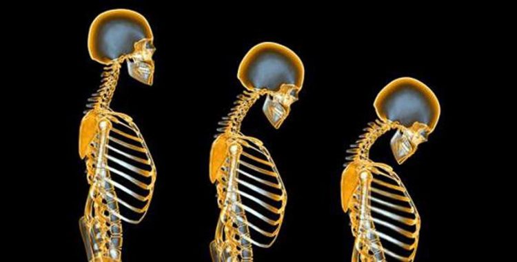 Vấn đề loãng xương - Những gì bác sĩ không nói cho bạn biết về xương của bạn