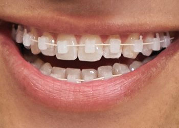 Niềng răng 3M Clarity Ultra, ứng dụng công nghệ vì nụ cười đẹp tự nhiên - 08