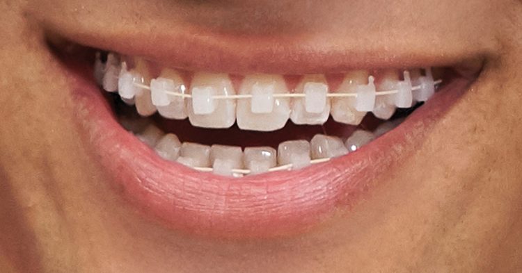 Niềng răng 3M Clarity Ultra, ứng dụng công nghệ vì nụ cười đẹp tự nhiên - 08