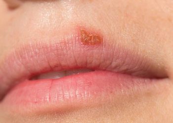 2 loại virus gây mụn rộp kết hợp nhau tạo chủng mới kháng thuốc - 1