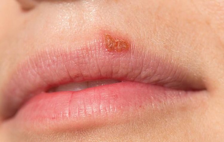 2 loại virus gây mụn rộp kết hợp nhau tạo chủng mới kháng thuốc - 1