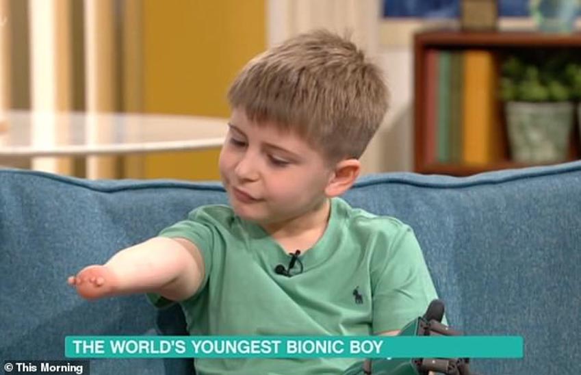 Người trẻ nhất thế giới được gắn cánh tay mô phỏng sinh học đa năng tiên tiến -1