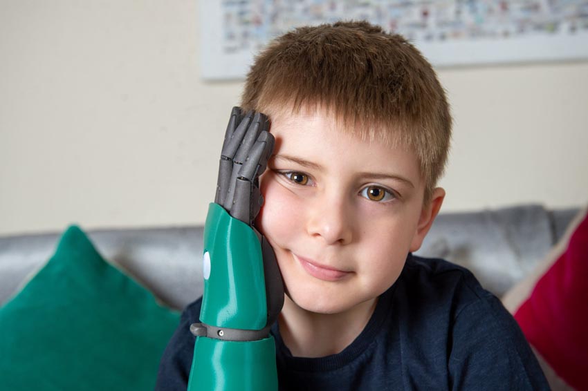 Người trẻ nhất thế giới được gắn cánh tay mô phỏng sinh học đa năng tiên tiến -8