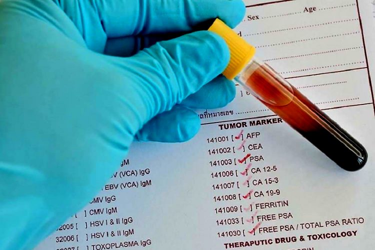 Chất chỉ điểm ung thư: chưa chắc “án tử” đã tuyên