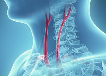 “Hẹp động mạch cảnh dễ gây ra tai biến mạch máu não (đột quỵ nhồi máu não), có thể dẫn đến tử vong hoặc để lại những hậu quả nặng nề như liệt, rối loạn ngôn ngữ - 02