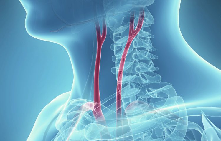 “Hẹp động mạch cảnh dễ gây ra tai biến mạch máu não (đột quỵ nhồi máu não), có thể dẫn đến tử vong hoặc để lại những hậu quả nặng nề như liệt, rối loạn ngôn ngữ - 02