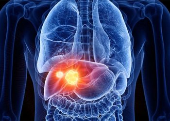 Ung thư gan: cách phòng và trị -1