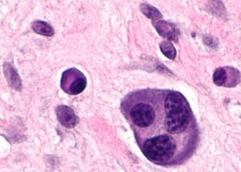 Phát hiện cách ‘bật’ cơ chế tự hủy ung thư ngay trong cơ thể