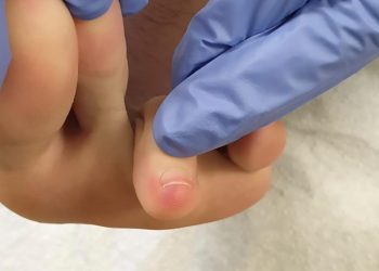 Sưng loét bàn chân có thể là triệu chứng ban đầu của nhiễm vi rút corona