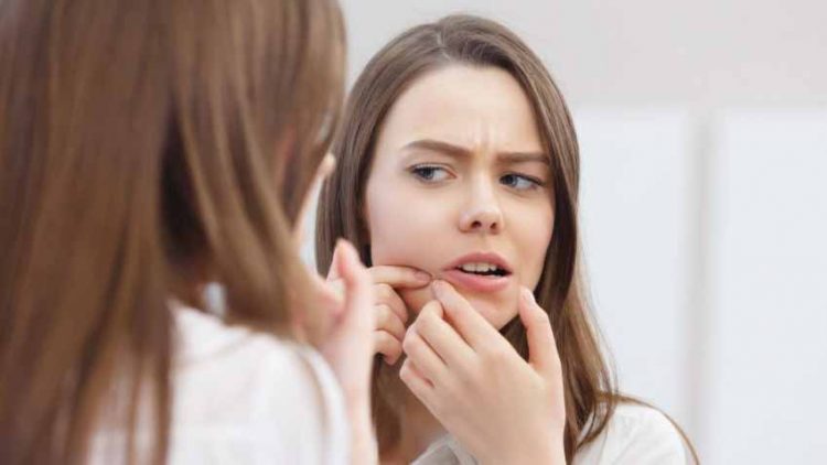 Mụn trứng cá nói gì về sức khỏe của bạn? -5