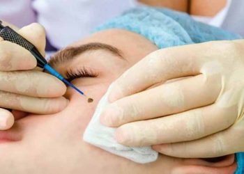 Phá nốt ruồi cải số, làm đẹp: Coi chừng ung thư!