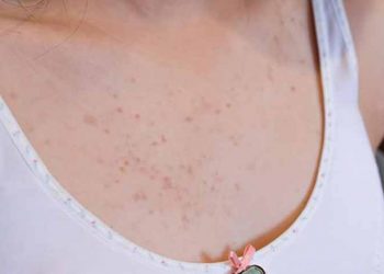 Cách xử lý khi nổi mụn ở ngực -1