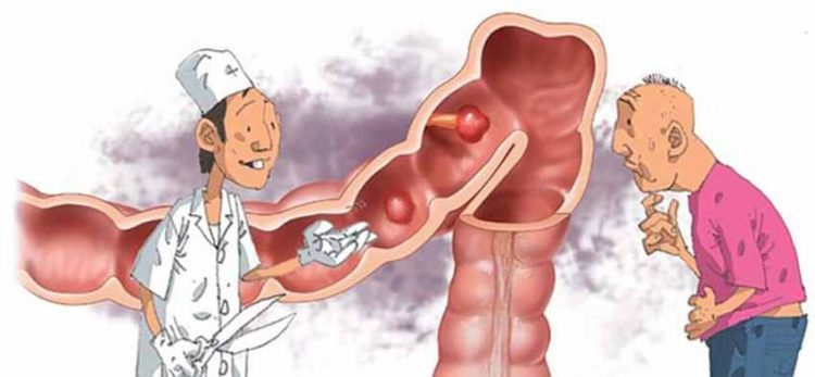 Cắt sạch polyp liệu còn nguy cơ ung thư?