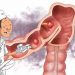 Cắt sạch polyp liệu còn nguy cơ ung thư?