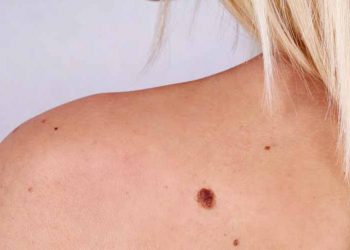 Nốt ruồi đến từ đâu?