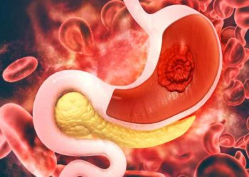 Ung thư dạ dày sớm: Đừng để 'biết thì đã muộn'! - 3