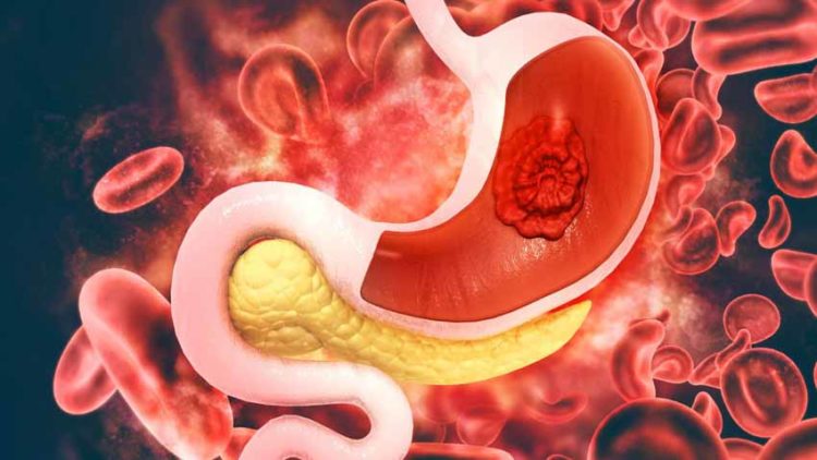 Ung thư dạ dày sớm: Đừng để 'biết thì đã muộn'! - 3