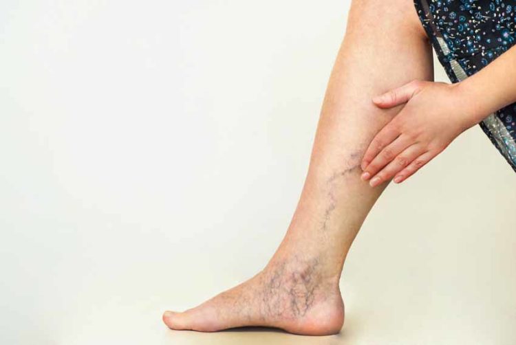 6 ngộ nhận về chứng giãn tĩnh mạch - 1