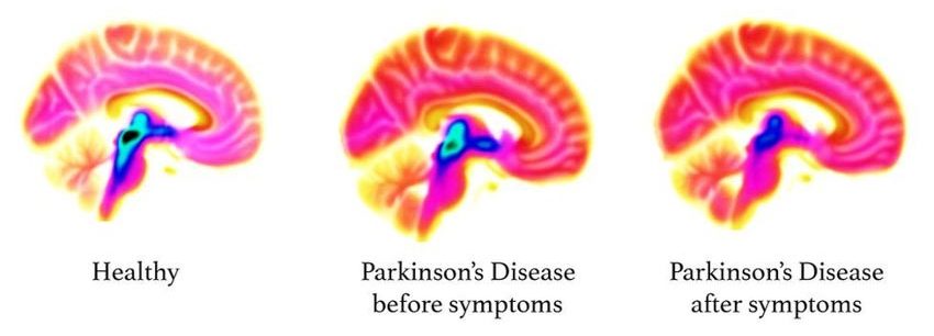 Người phụ nữ có thể ngửi thấy bệnh Parkinson - 2