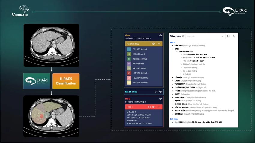 VinBrain triển khai AI sàng lọc Lao và ra mắt tính năng phân loại gan LI-RADS - 3