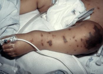 Hội thảo ra mắt sách dự phòng bệnh do não mô cầu ở Việt Nam