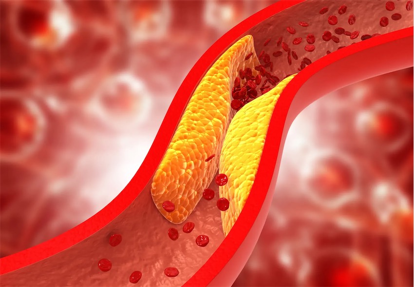 Cholesterol cao là yếu tố nguy cơ của bệnh tim mạch, nhồi máu cơ tim và đột quỵ.